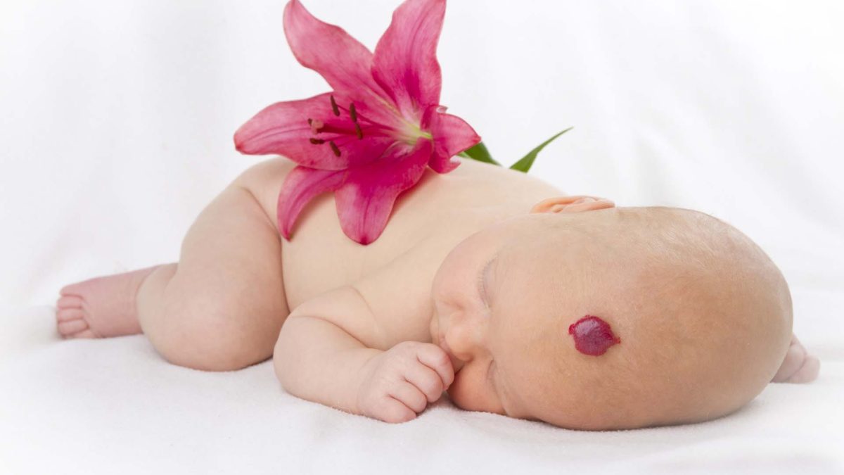 little baby with hemangioma