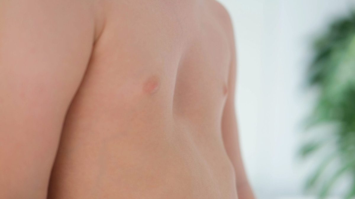 A child with a pectus excavatum. Rickets is a consequence of vitamin D deficiency.
