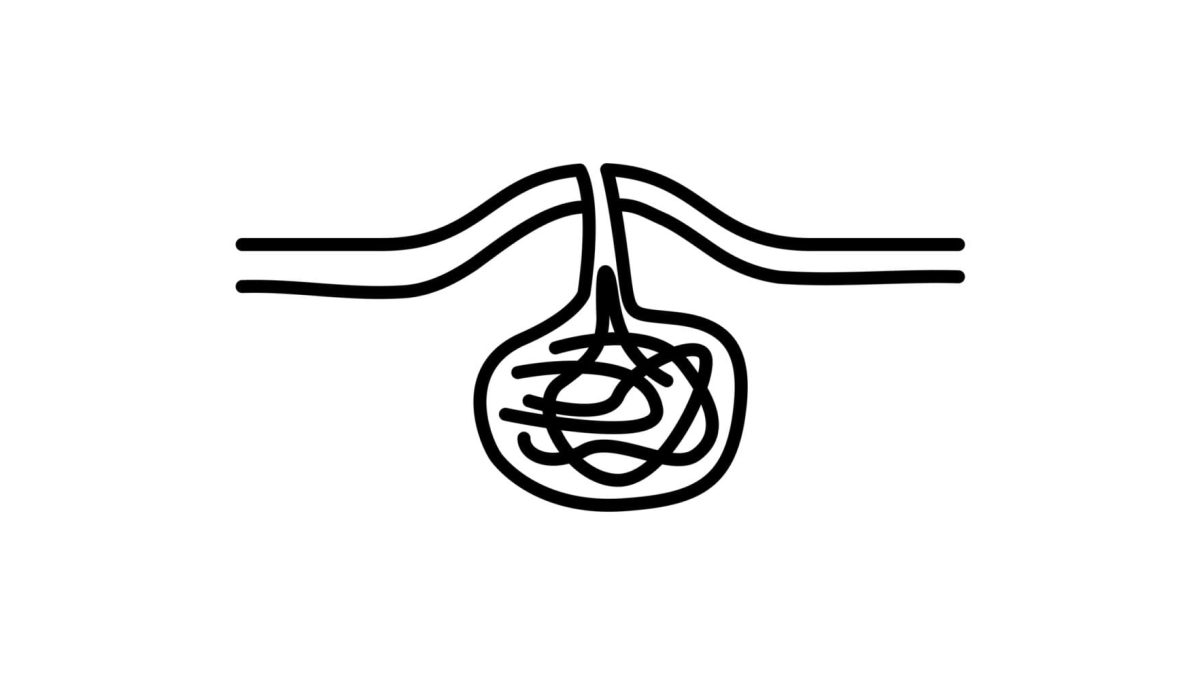vector illustration of a pilonidal cyst