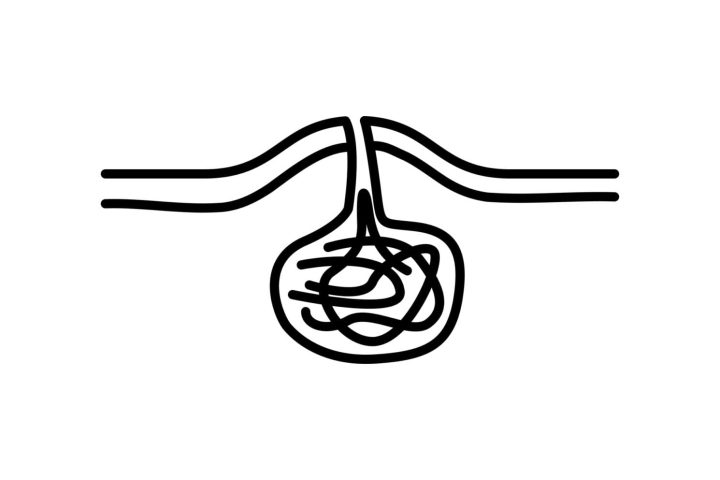 vector illustration of a pilonidal cyst