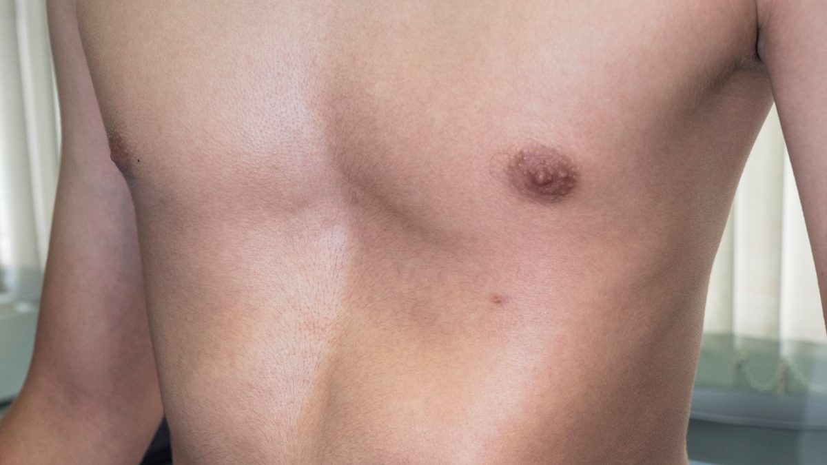 A child with a chest wall deformity in Conejo Valley
