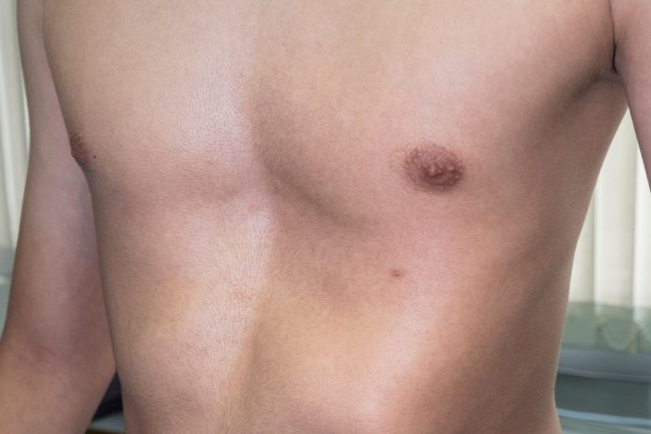 A child with a chest wall deformity in Conejo Valley
